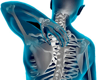 Manifestaties van osteochondrose van de thoracale wervelkolom