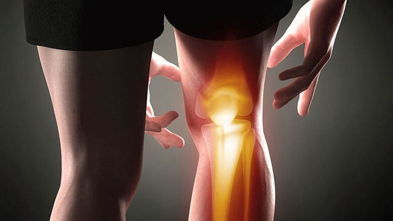 Arthrose van het kniegewricht