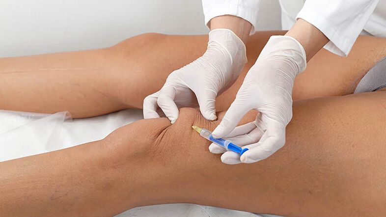 Intra -articulaire injectie voor artrose van de knie