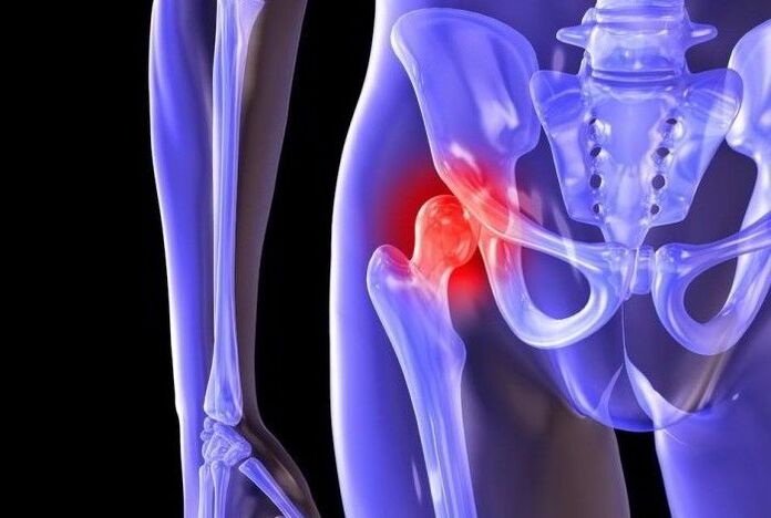 Pathologisch proces in het heupgewricht met coxartrose